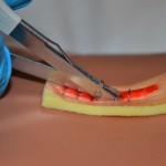 Continue to remove every second staple to the end of the incision line