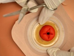 colostomy care procedure