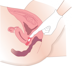 Administering medication vaginally without an applicator 