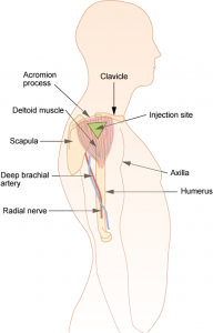 Deltoid intramuscular injection