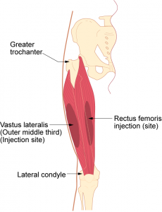 Vastus lateralis intramuscular injection