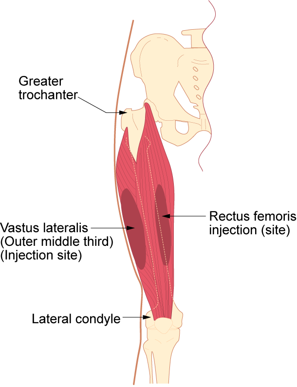 intramuscular injection diagram
