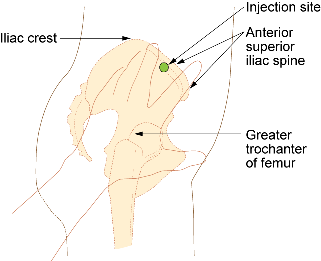 a) Comparison between thighs, deep intramuscular, slight
