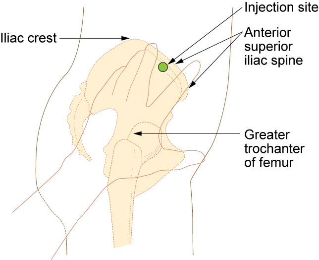 rectus femoris injection site