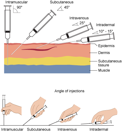 Iv Placement Chart