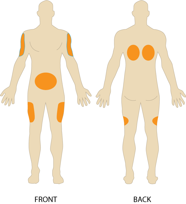 intradermal injection sites