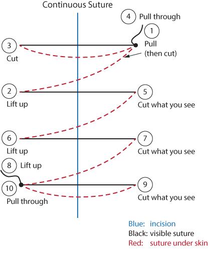 Suture Removal Chart