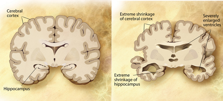 In a brain with Alzheimer’s, the cerebral cortex and the hippocampus shrink and ventricles enlarge.