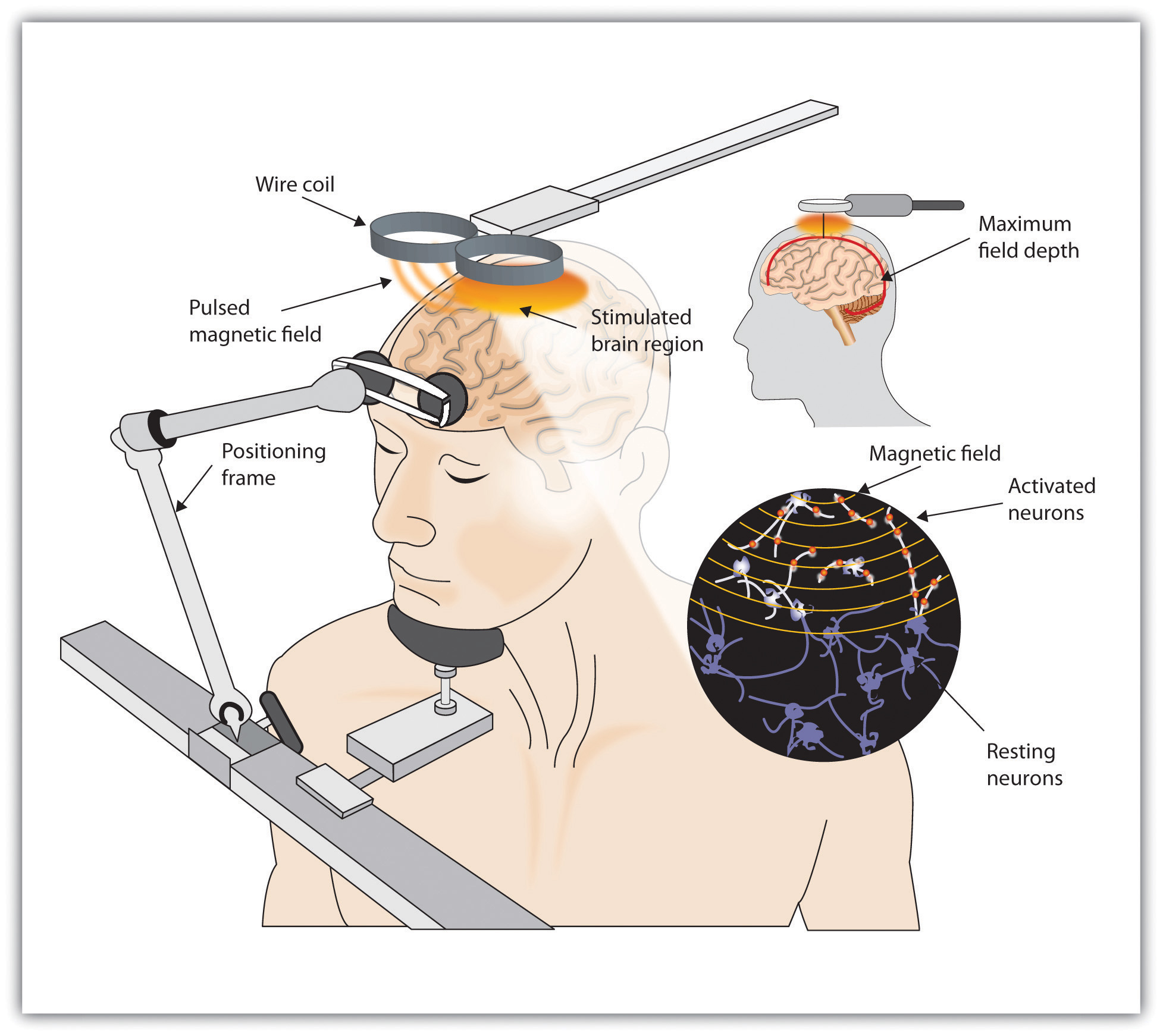 14.2 Reducing Disorder Biologically: Drug And Brain Therapy ...