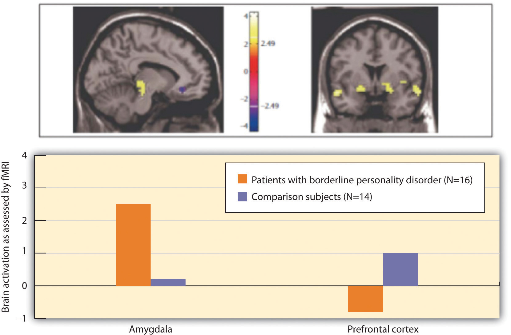 Three-Factor Model of the DSM-IV Borderline Personality Disorder