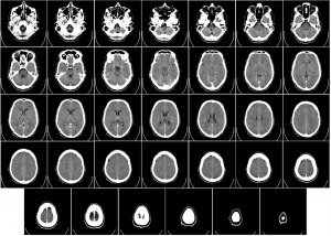 34 pictures of a brain. The last 6 show the brain decreasing in size.