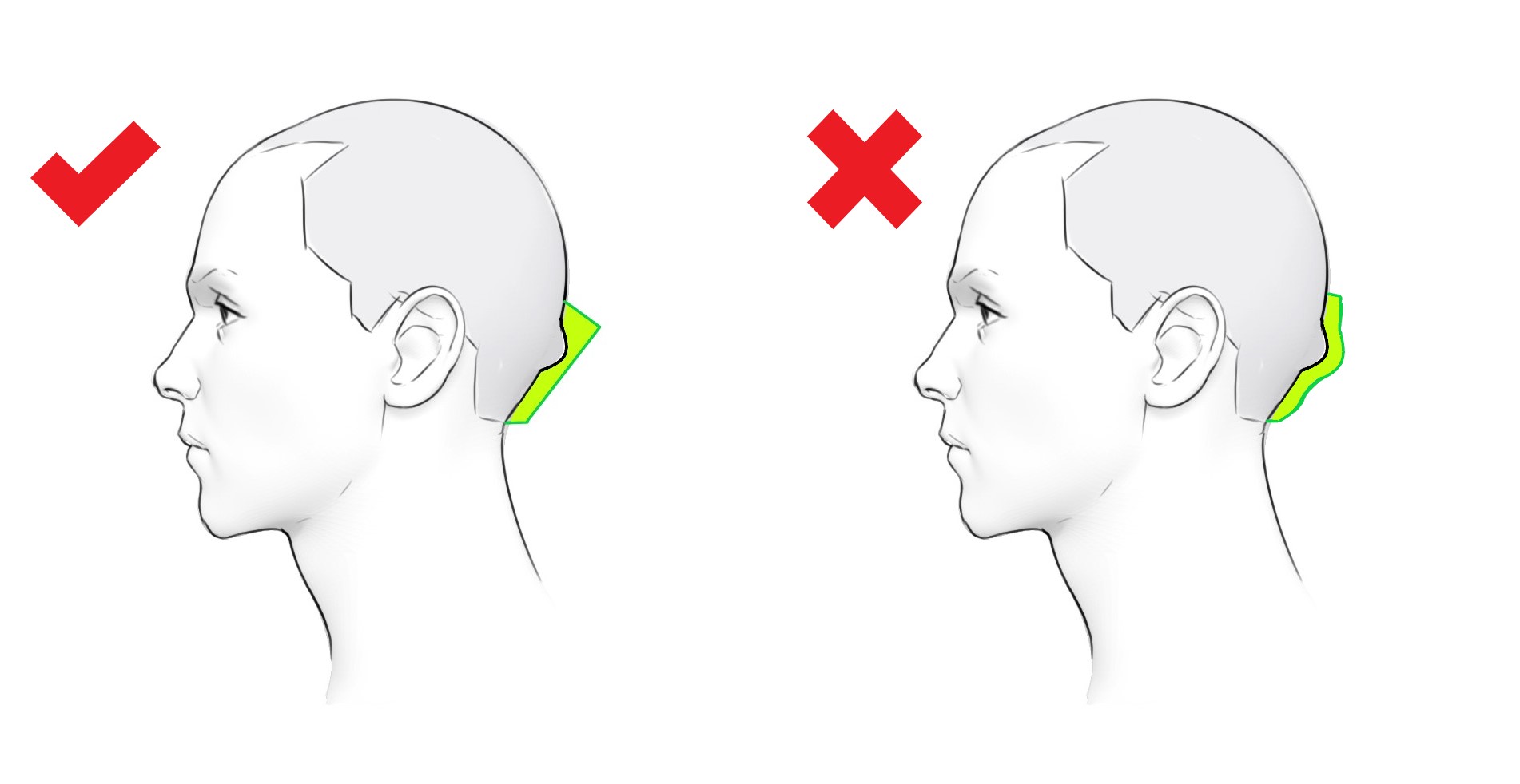 Image showing difference in balance of hair around occipital bone