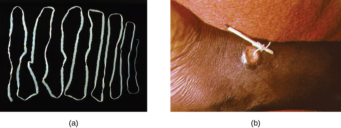 Photo of tapeworm. Second photo shows removal of tapeworm.