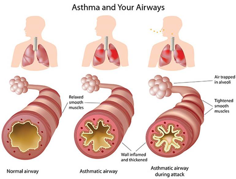 Diagrams of a normal airway, an asthmatic airway, and an asthmatic airway during attack. Full description linked in caption.