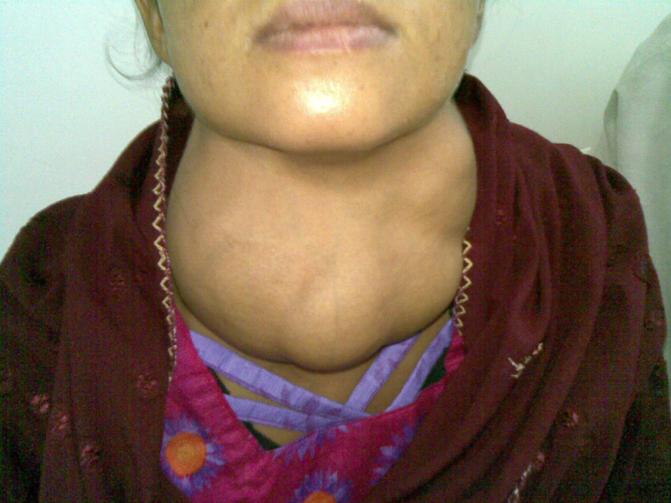 A person with a very swollen, rounded, bumpy lump coming out of their neck, almost like a frog’s vocal sac.