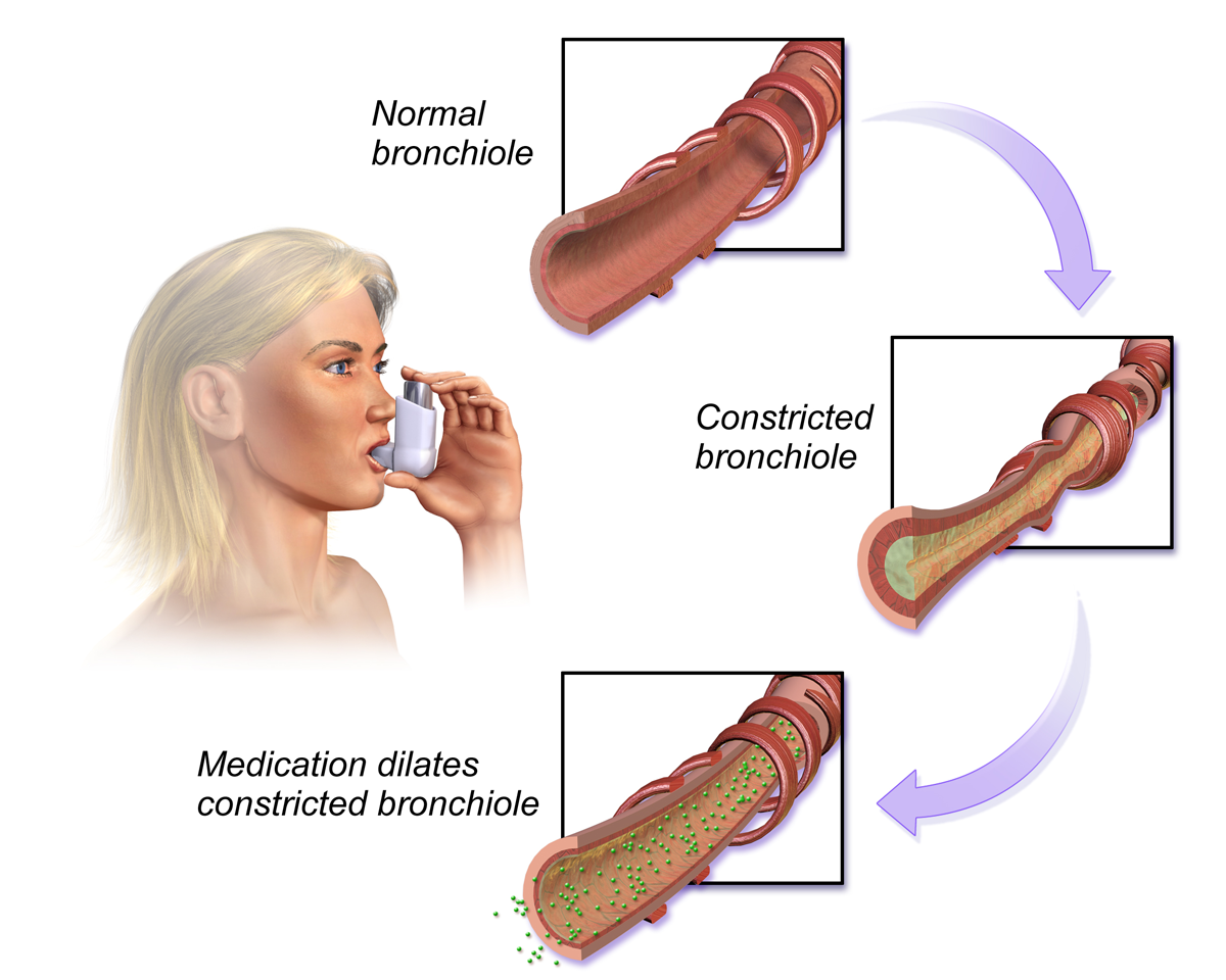 Images showing affect of asthma medication on bronchiole, as a woman inhales the medication.