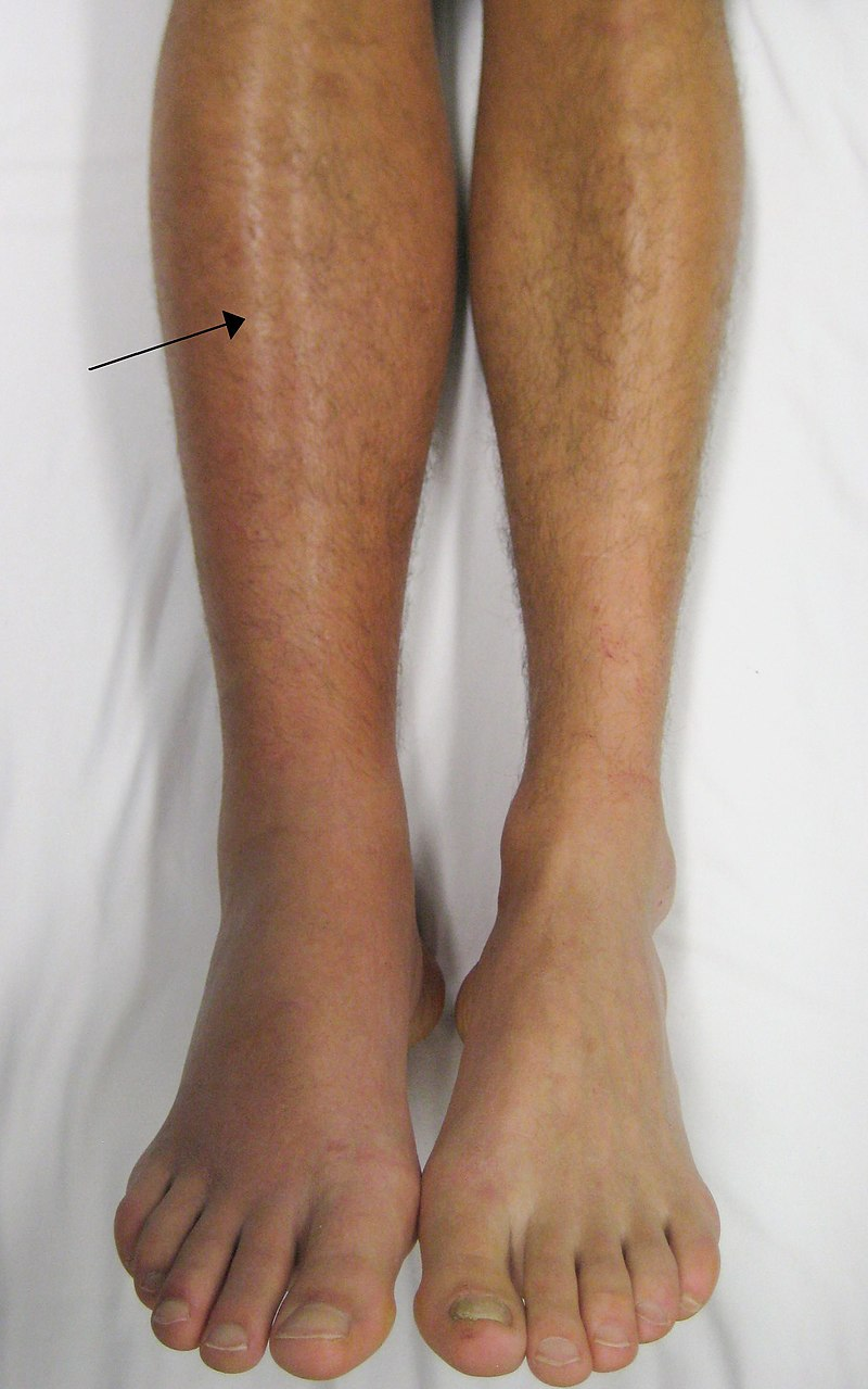 A peron's shins and feet. The right leg is a darker colour than the left leg.