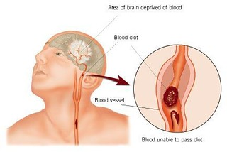 A clot in a blood vessel leading to the brain results in an area of the brain being denied blood.