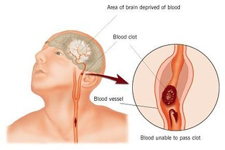 Illustration, with labels, showing stroke