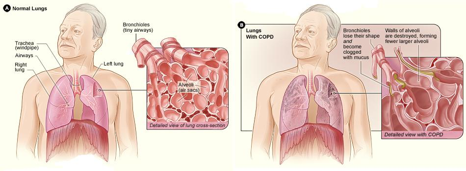 Illustrations comparing normal lungs with C O P D lungs.