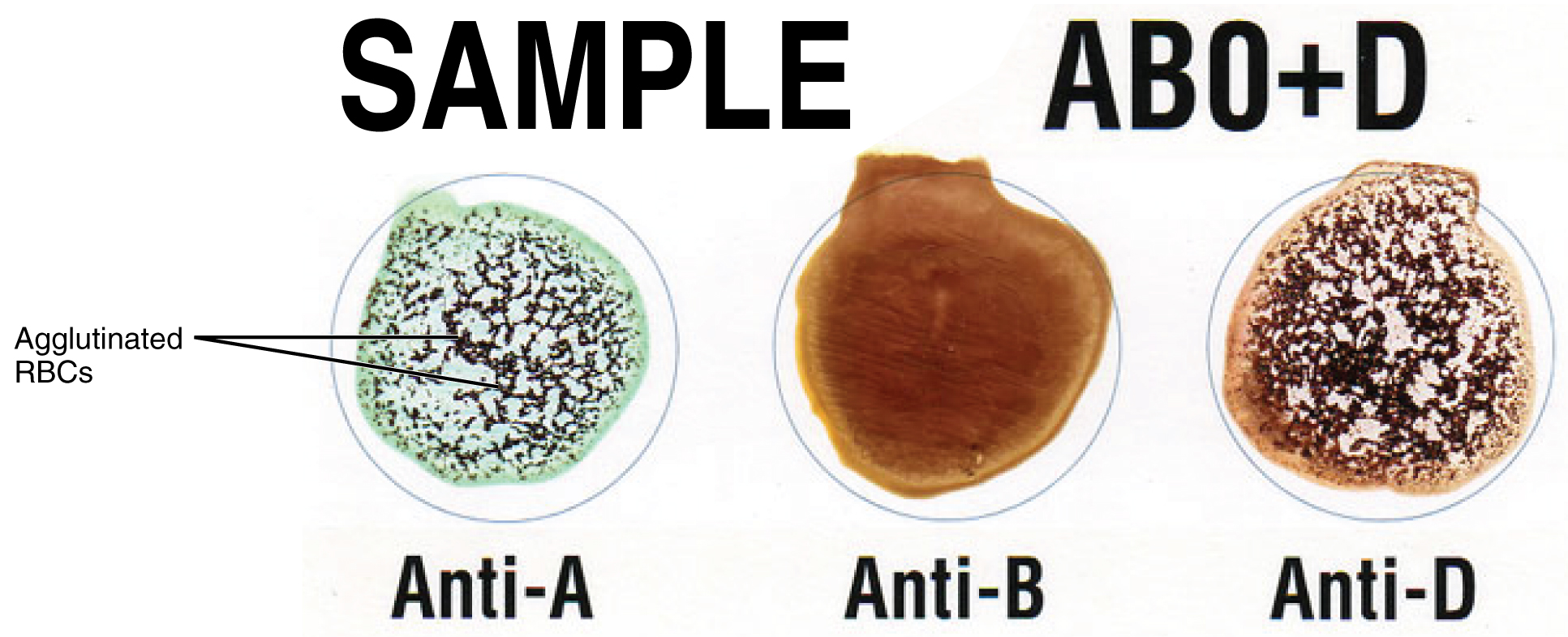 Blood Type Agglutination Chart