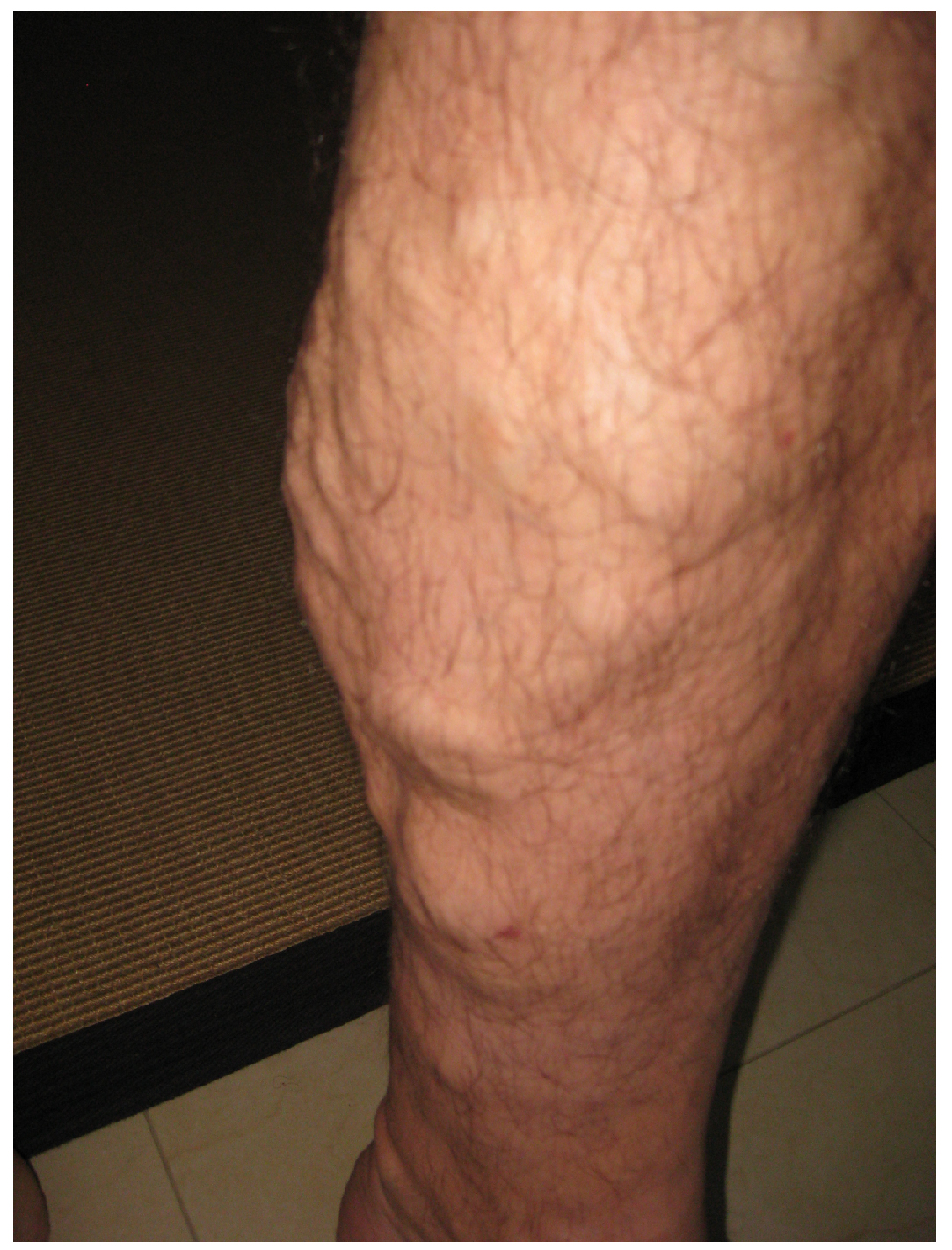 This photo shows a person’s leg with varicose veins