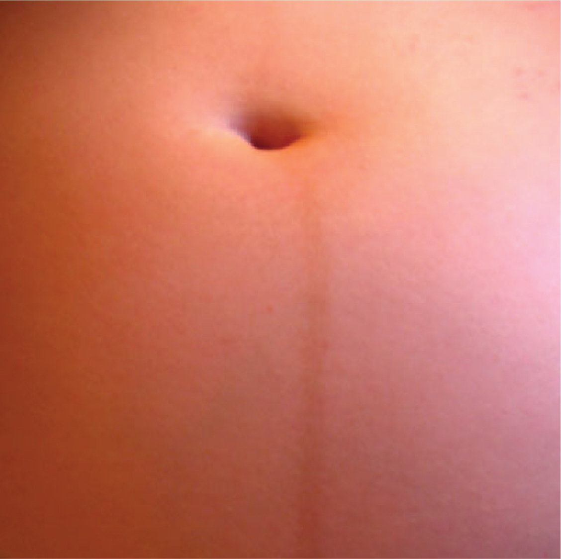 This photo shows a dark line below a woman’s navel.