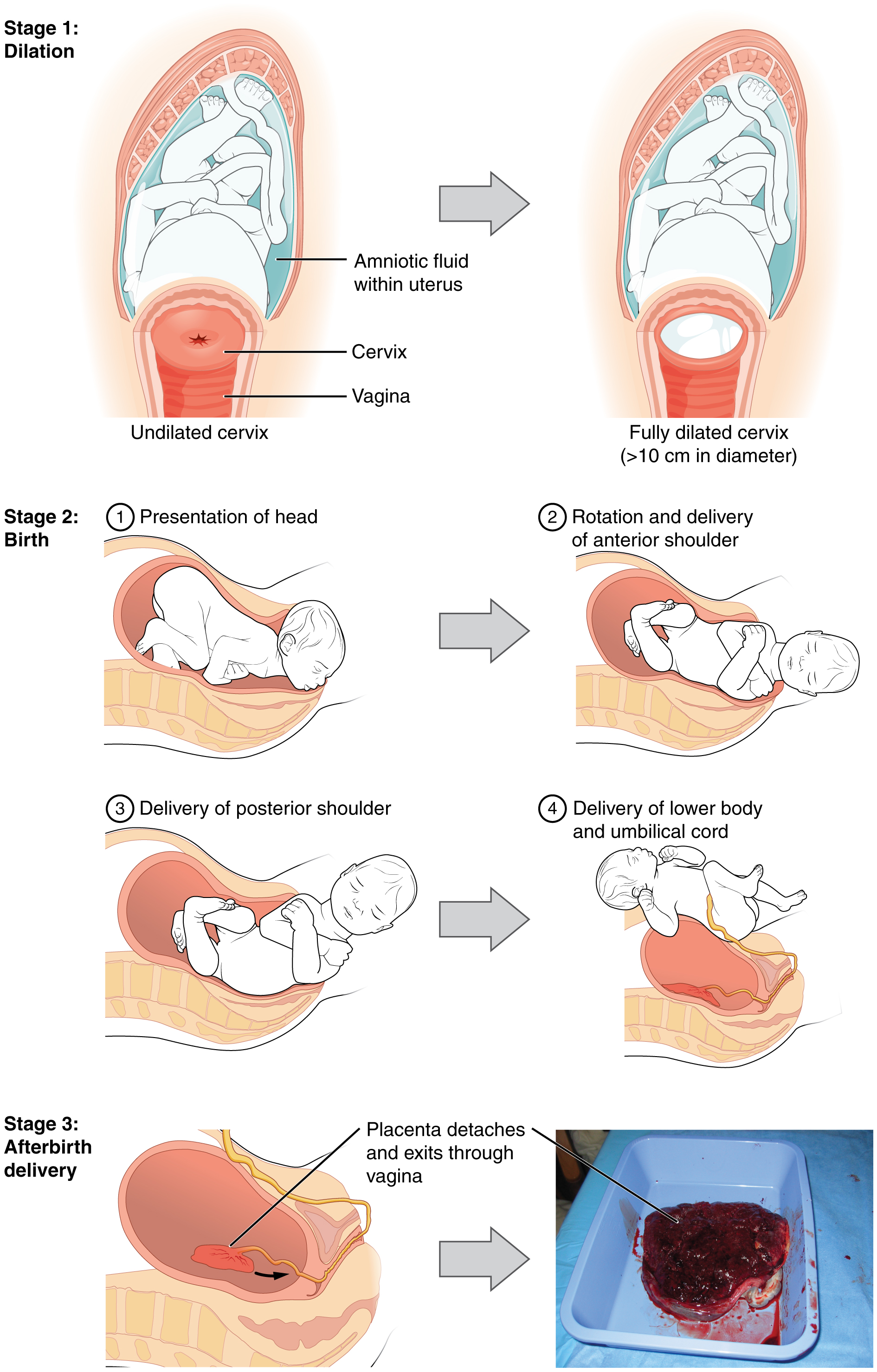 A textbook of obstetrics . Fig. 253. Presentation I the umbili