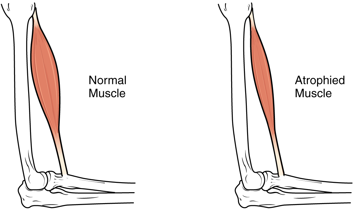 This image shows muscle atrophy. The left panel shows normal muscle and the right panel shows atrophied muscle.