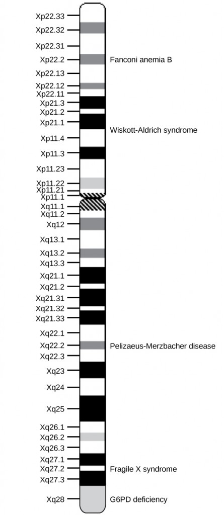 A diagram showing a human chromosome with bands revealed with a Giemsa stain. The bands are labeled with Xp and a number on the short arm and Xq and a number on the long arm. Certain genes are found within some of the bands. These genes are labeled on the right: Fanconi anemia B, Wiskott-Aldrich syndrome, Pelizaeus-Merzbacher disease, Fragile X syndrome, and G6PD deficiency[0].