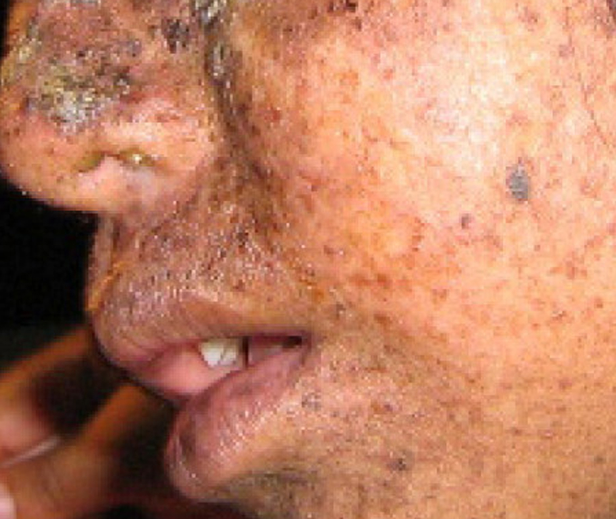 Photo shows a person with mottled skin lesions that result from xermoderma pigmentosa.