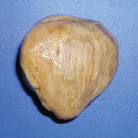 The patella is a flat, teardrop-shaped bone.