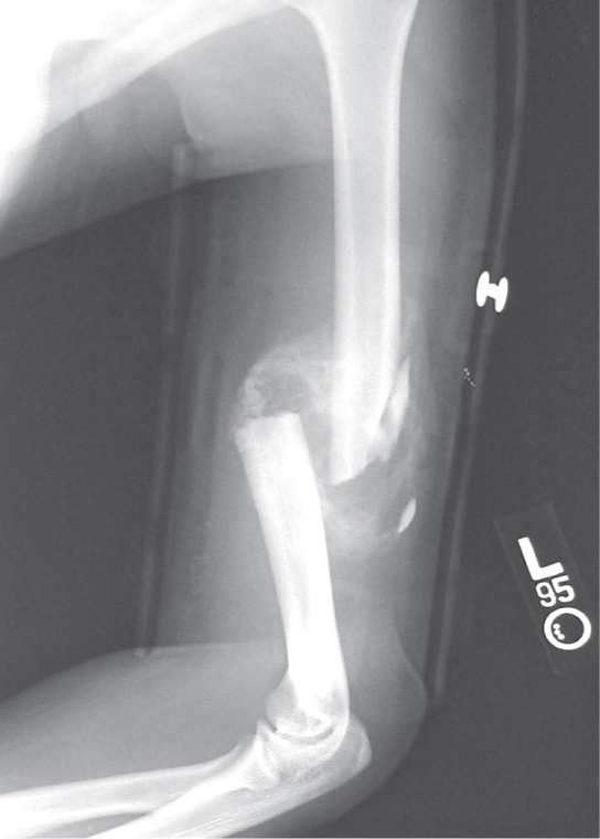 Photo shows an X-ray of a broken humerus—the bone in the upper arm.