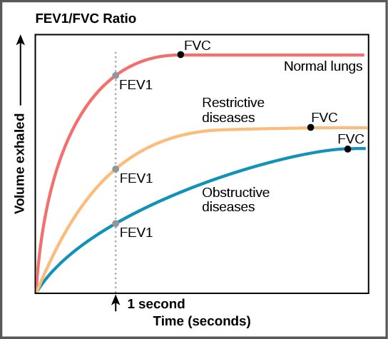 The graph plots volume exhaled versus time. In normal lungs, almost all of the air can be forcibly exhaled within one second after taking a deep breath, resulting in a curve that rises steeply at first then plateaus shortly after one second. The volume at which the plateau is reached is the FV C . In lungs of persons with restrictive lung disease, the F V C is considerably lower but the person can exhale reasonable fast, resulting in a curve that is similar in shape, but with a lower plateau, or F V C, than for normal lungs. In lungs of persons with obstructive lung disease, the F V C is low and exhalation is much slower, resulting in a flatter curve with a lower plateau.