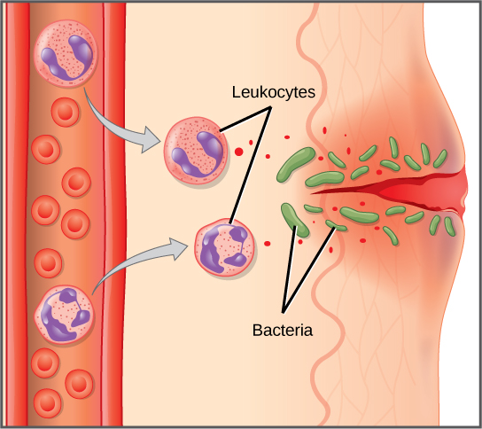Illustration shows a capillary near the surface of skin that has a cut in it. Bacteria have penetrated the skin around the cut. In response, mass cells in the lower part of the skin tissue release histamines, and dendritic cells release cytokines. The histamines cause the capillary to become permeable. Neutrophils and monocytes exit the capillary into the damaged skin. Both the neutrophil and macrophage release cytokines and consumes bacteria by phagocytosis.