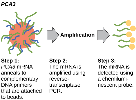 The P C A 3 test occurs in three steps. In step one, P C A 3 m R N A anneals to complementary D N A primers that are attached to beads. In step two, the m R N A is amplified using reverse-transcriptase P C R. In step three, the mRNA is detected using a chemiluminescent probe.