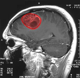 An MRI image of a patient's brain with a tumor highlighted in red.