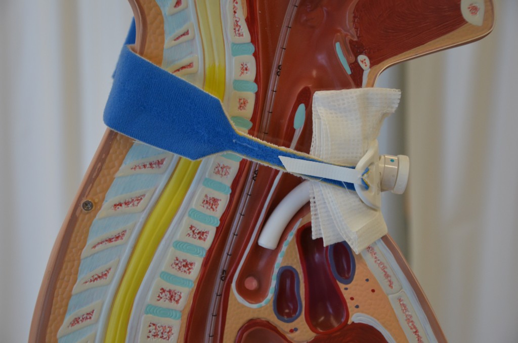 10.5 Tracheostomies Clinical Procedures for Safer Patient Care