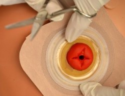 10.7 Ostomy Care – Clinical Procedures for Safer Patient Care