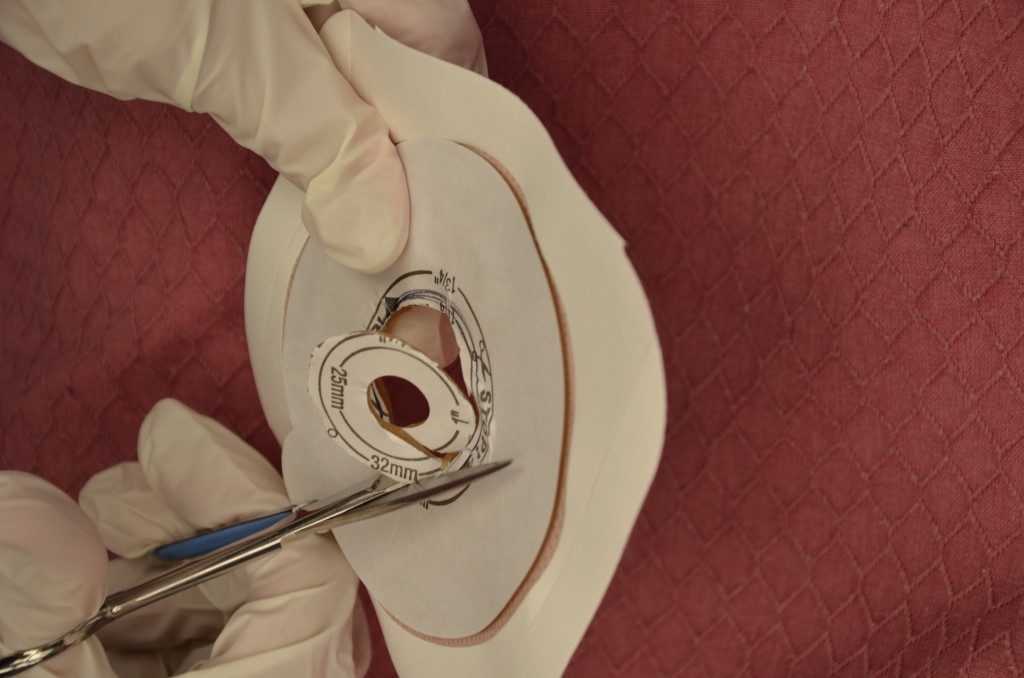 10.7 Ostomy Care Clinical Procedures for Safer Patient Care