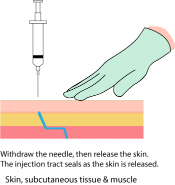 7.4 Intramuscular Injections – Clinical Procedures for Safer Patient Care