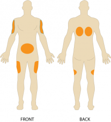 7.3 Intradermal and Subcutaneous Injections – Clinical Procedures for ...