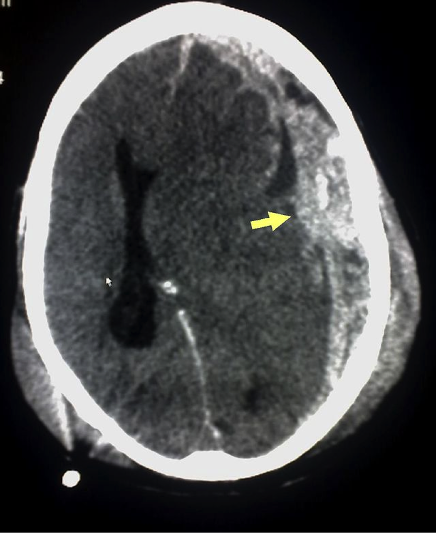 subdural hematoma