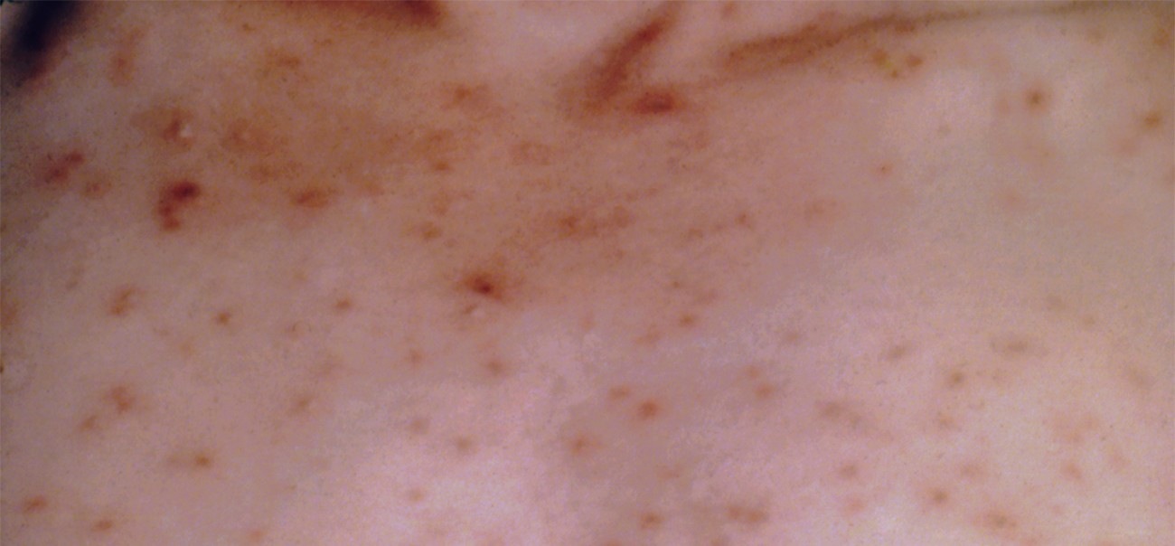 Photo of chickenpox rash on the back of a person’s shoulders.