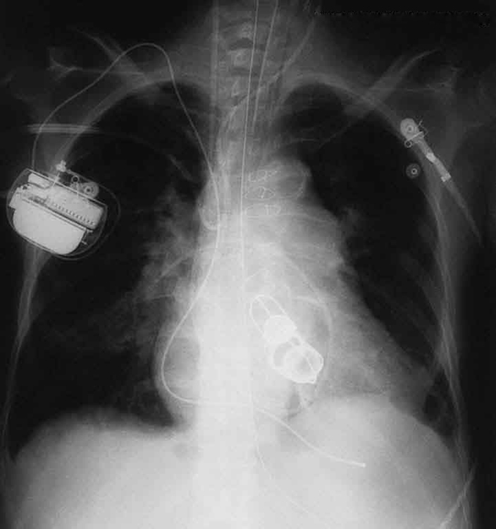An X ray image of the chest is shown. It shows the section of the heart with artificial heart valves, a pacemaker, and the wires used to close the sternum.