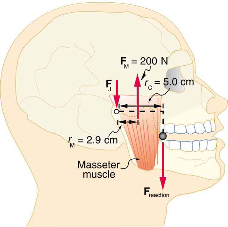 The masseter muscles of a jaw of a man are shown. The force F sub M is equal to two hundred newtons and is acting on the muscle in upward direction and the force F sub J is acting to the left end of the muscle downward. The span of the muscle at upper part is five centimeters. At the joint of jaw, the reaction force is downward.