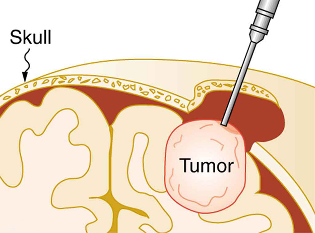 A picture of a brain tumor being removed from the skull using a clinical probe.