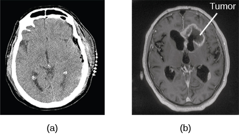 Image (a) shows a brain scan where the brain matter’s appearance is fairly uniform. Image (b) shows a section of the brain that looks different from the surrounding tissue and is labeled “tumor.”