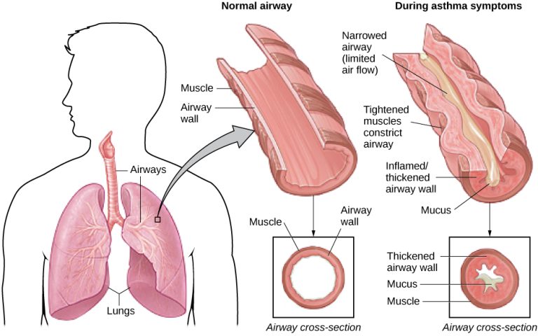 A silhouette of a person is shown with the lungs and airways labeled. There is an arrow coming from an airway in the lung leading to a magnification of a normal airway. A cross-section of the normal airway shows the muscle and the airway wall, with plenty of room for air to get through. An airway during asthma symptoms is also shown, and the labeled symptoms are narrowed airway (limited air flow), tightened muscles constricting airway, inflamed/thickened airway wall, and mucus. A cross-section of the airway during asthma symptoms shows the thickened airway wall, mucus and muscle. There is much less room for air to get through.